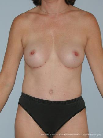 Tummy Tuck: Patient 1 - After  