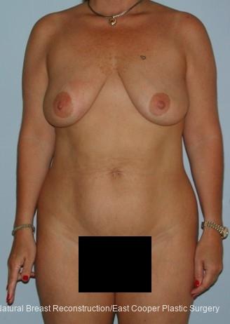 Tummy Tuck: Patient 4 - Before 1