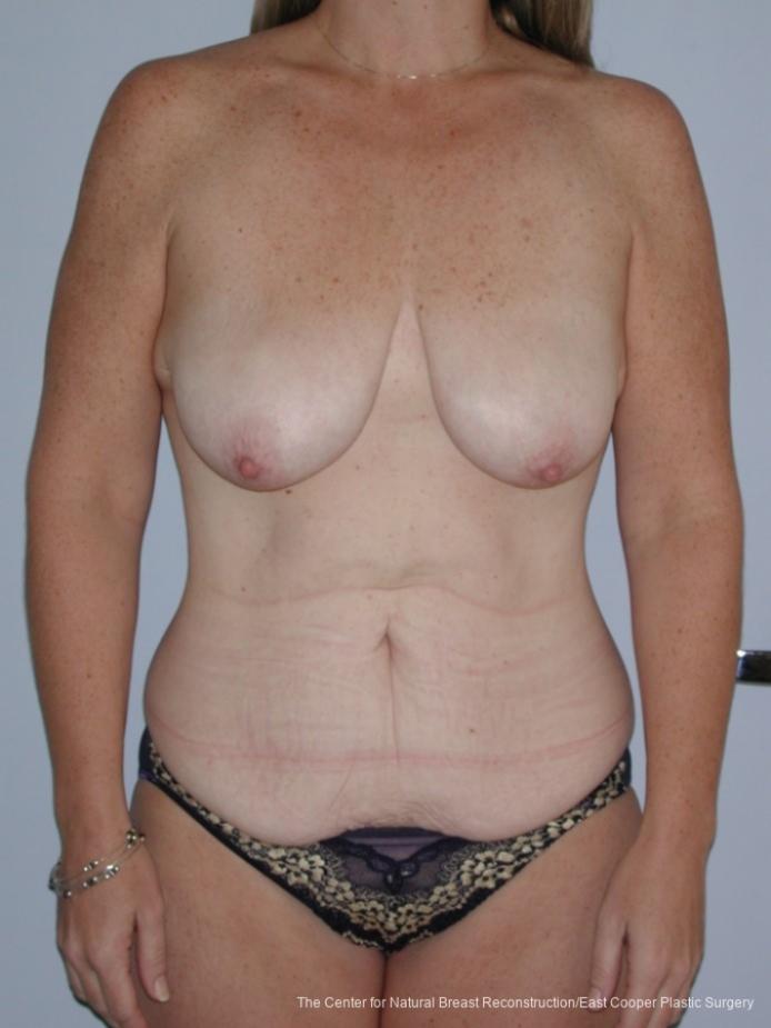 Tummy Tuck: Patient 10 - Before 1