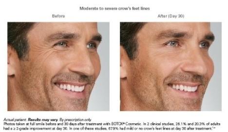 BOTOX® Cosmetic: Patient 3 - Before 