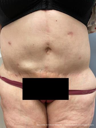 Secret RF: Patient 7 - Before 