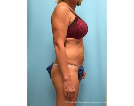 TruSculptiD: Patient 3 - Before 
