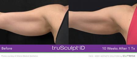 TruSculptiD: Patient 8 - Before 