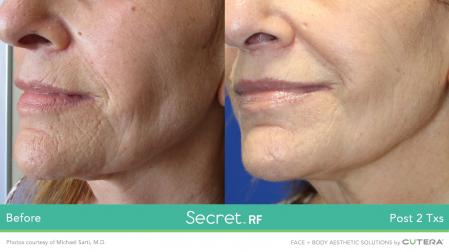 Secret RF: Patient 1 - Before 