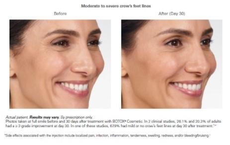 BOTOX® Cosmetic: Patient 1 - Before 1