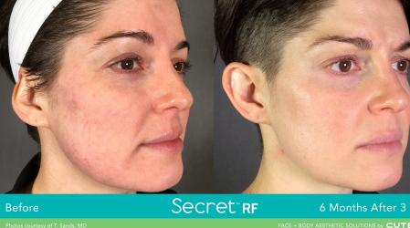 Secret RF: Patient 1 - After  