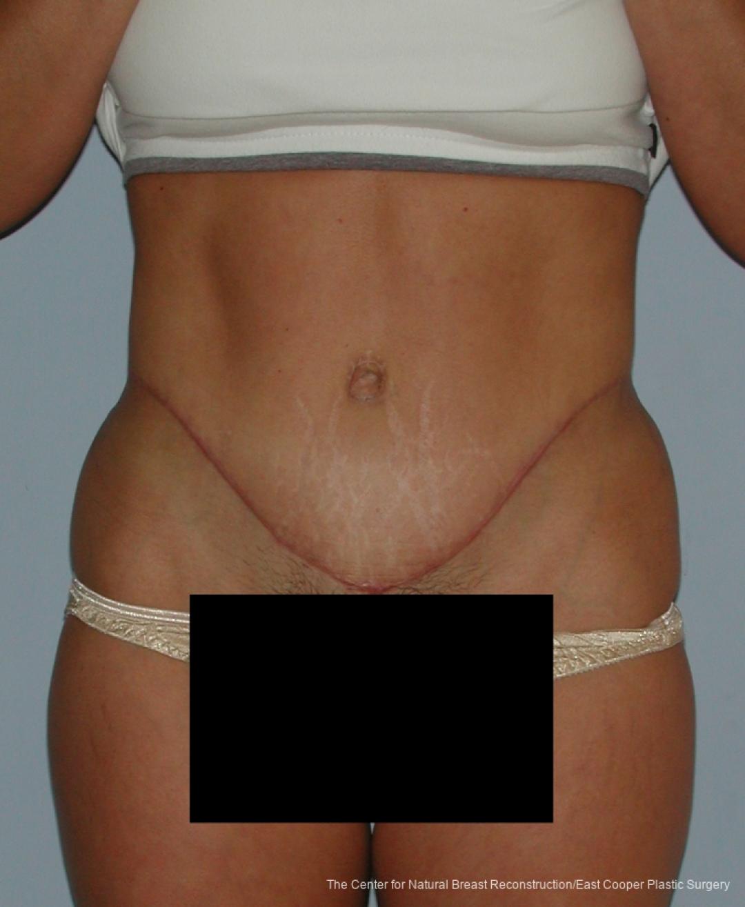 Tummy Tuck: Patient 7 - After 1