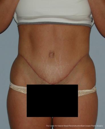 Tummy Tuck: Patient 7 - After  