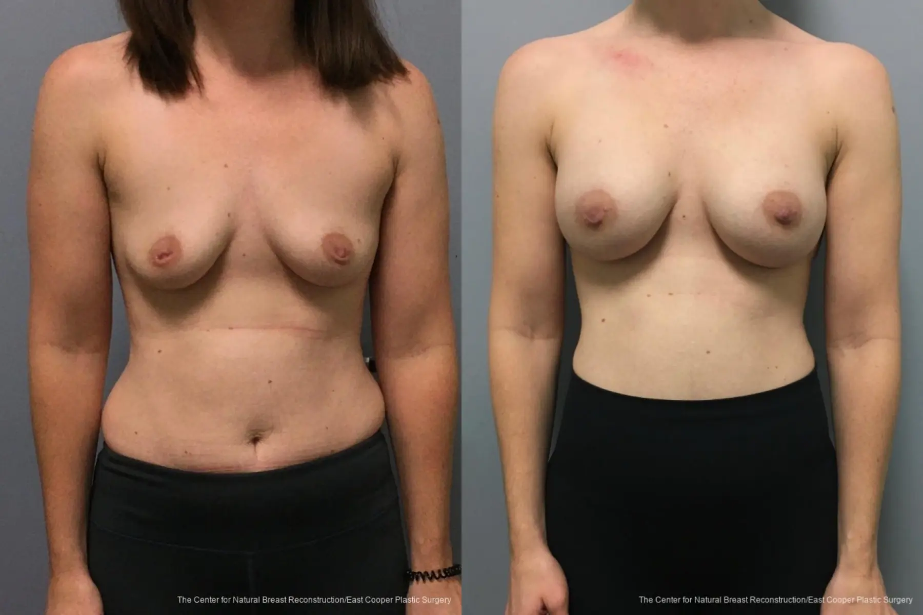 Breast Augmentation - Before and After