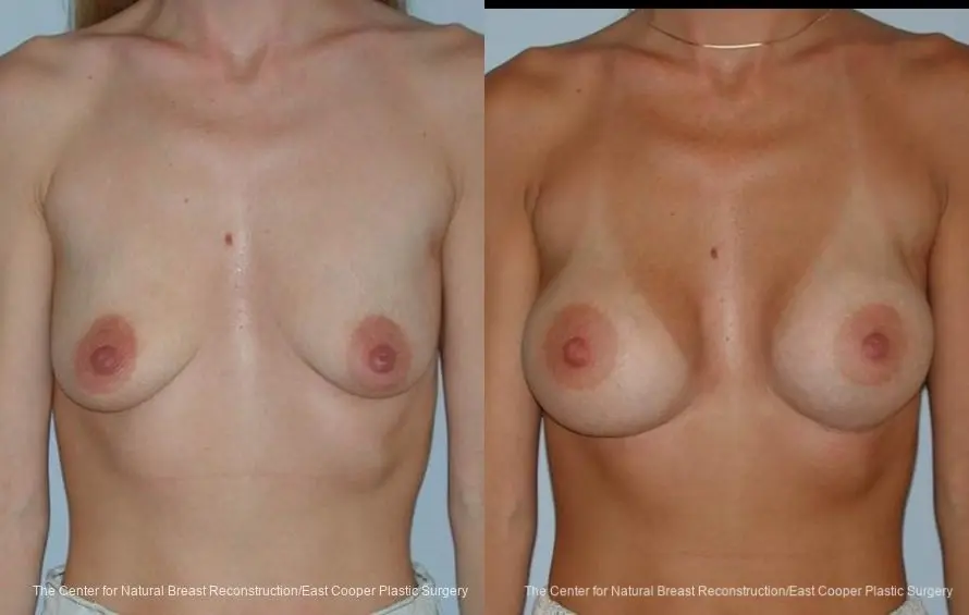 Breast Augmentation - Before and After