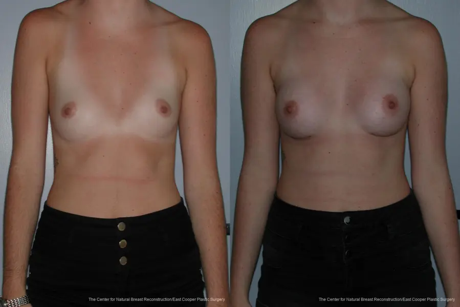 Breast Augmentation - Before and After