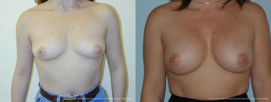 Breast Augmentation - Before and After