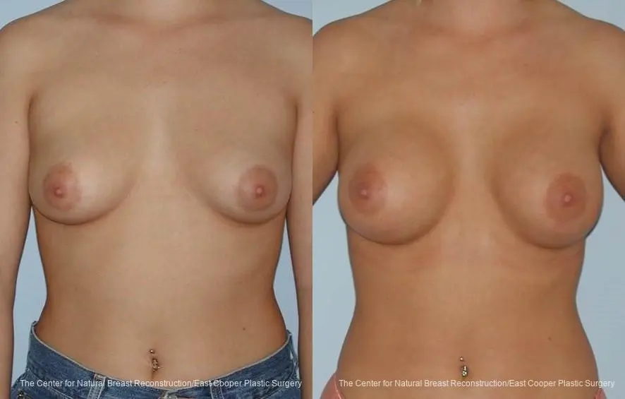 Breast Augmentation - Before and After