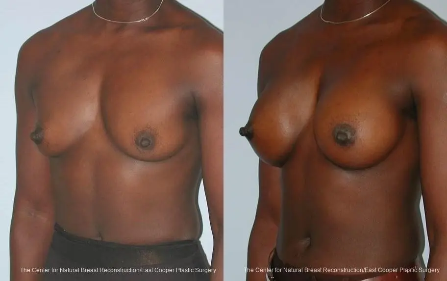 Breast Augmentation - Before and After