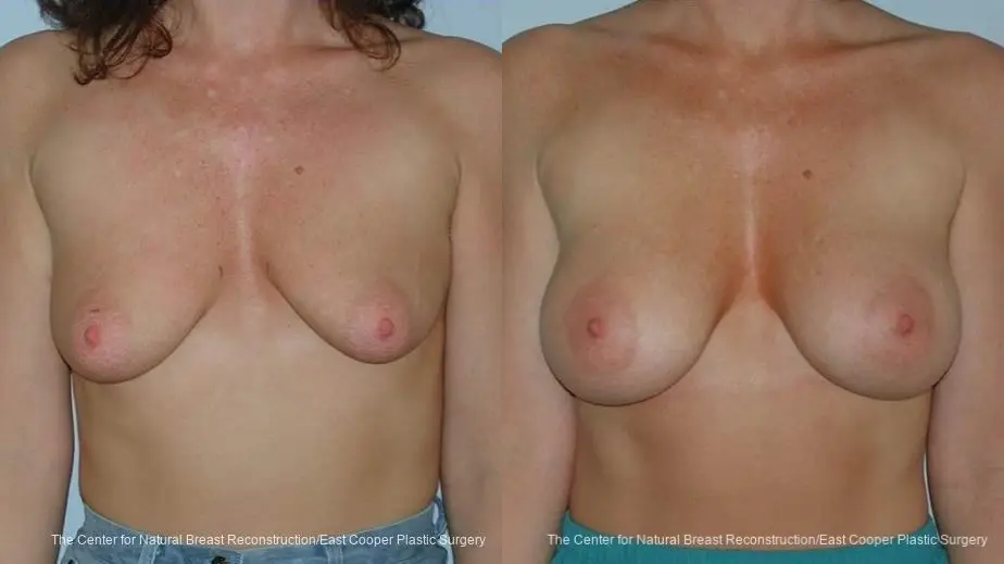 Breast Augmentation - Before and After