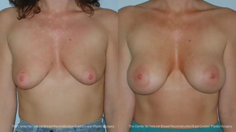 Breast Augmentation - Before and After