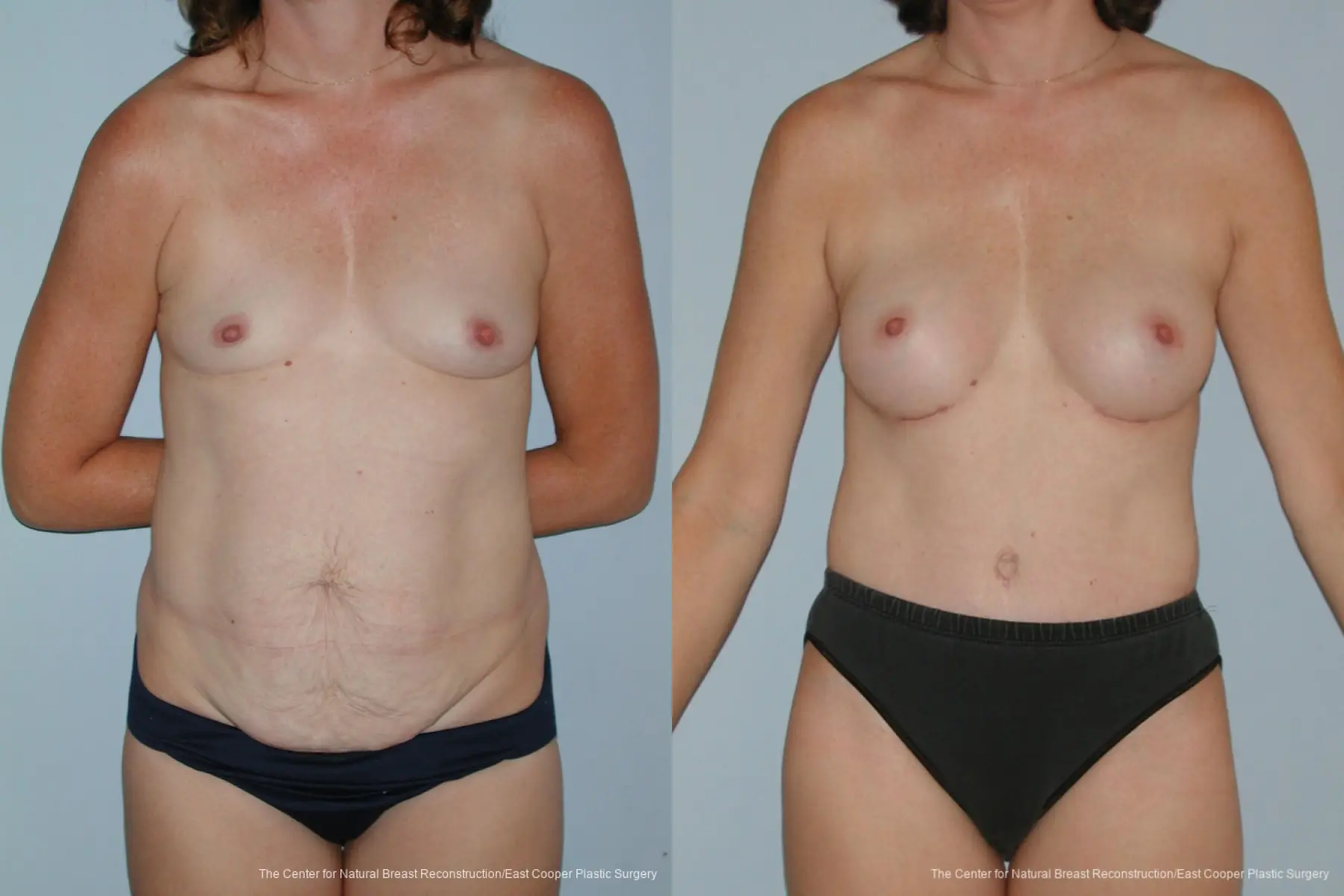 Breast Augmentation - Before and After