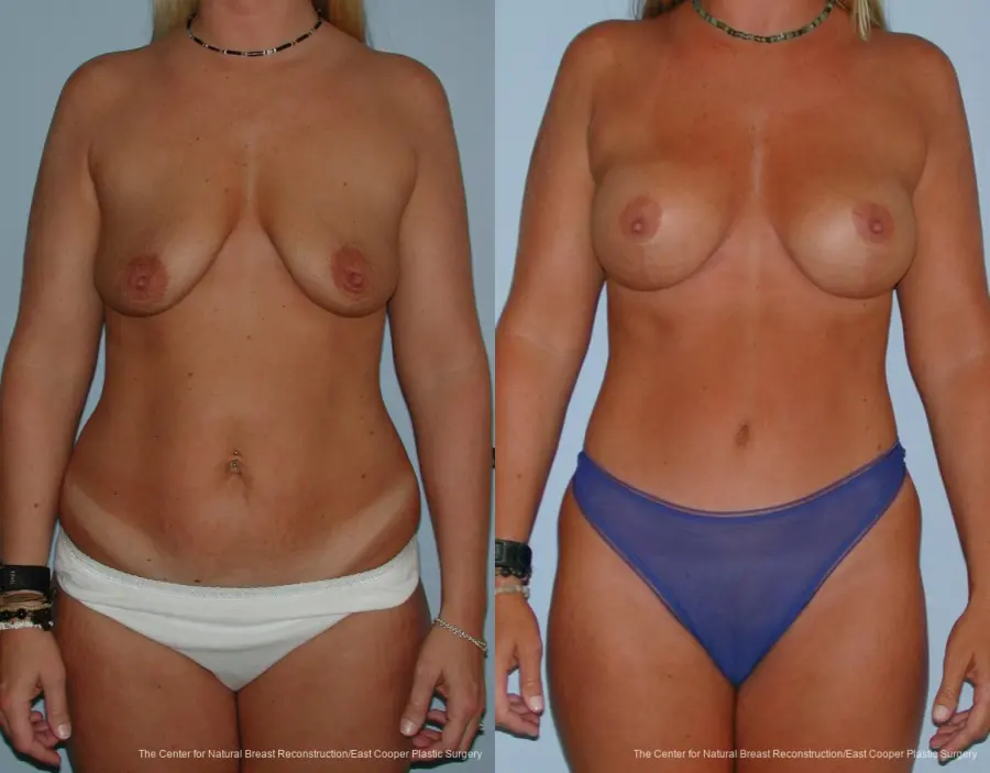 Breast Augmentation with Lift - Before and After