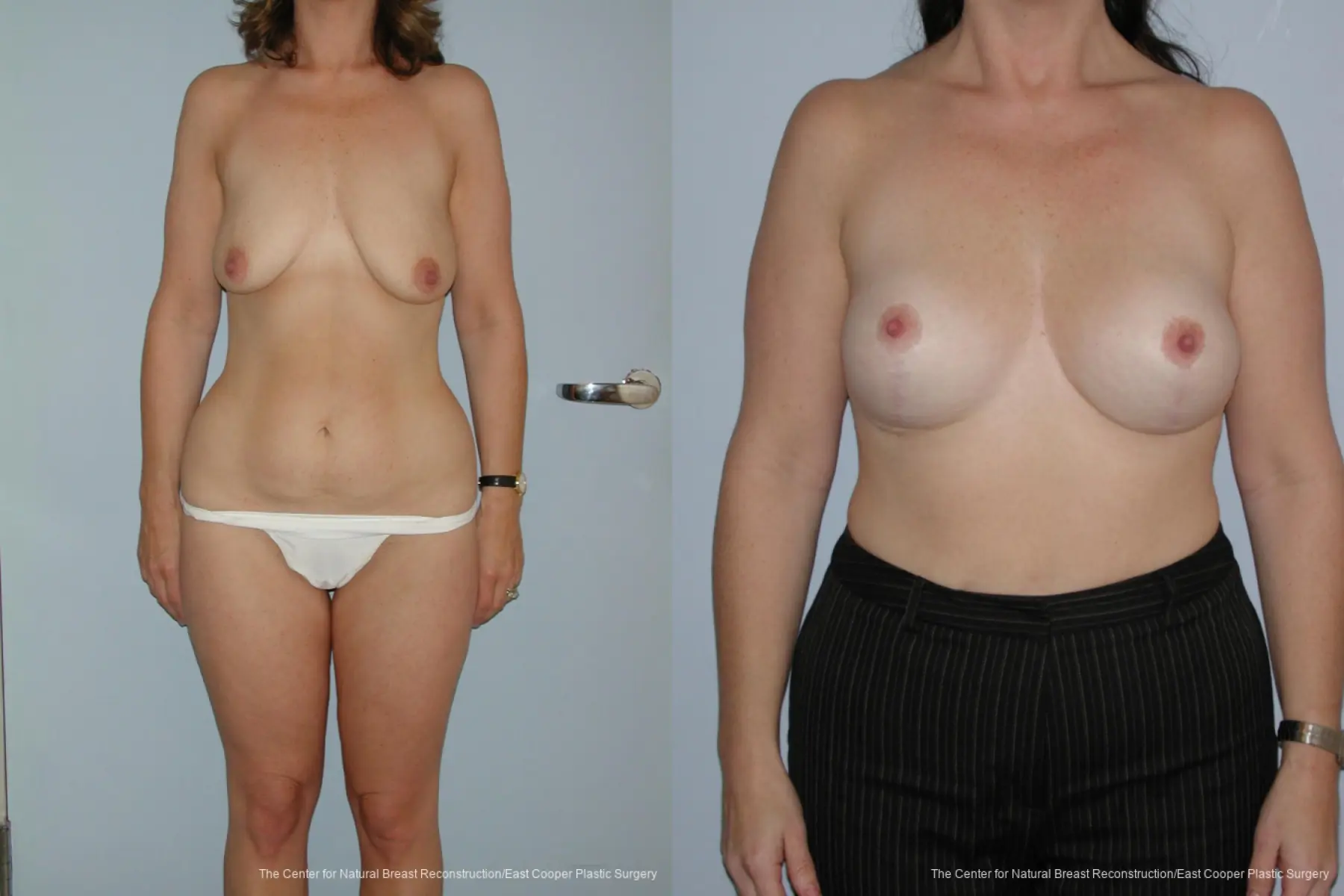 Breast Lift - Before and After 1
