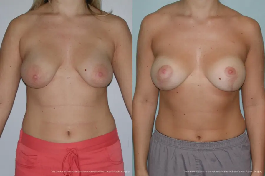 Breast Lift - Before and After