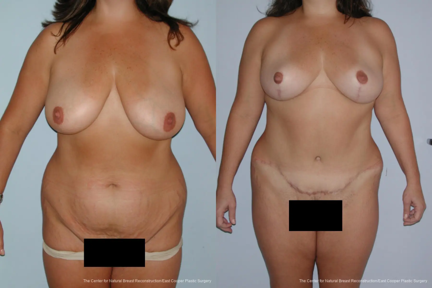 Breast Lift - Before and After 1