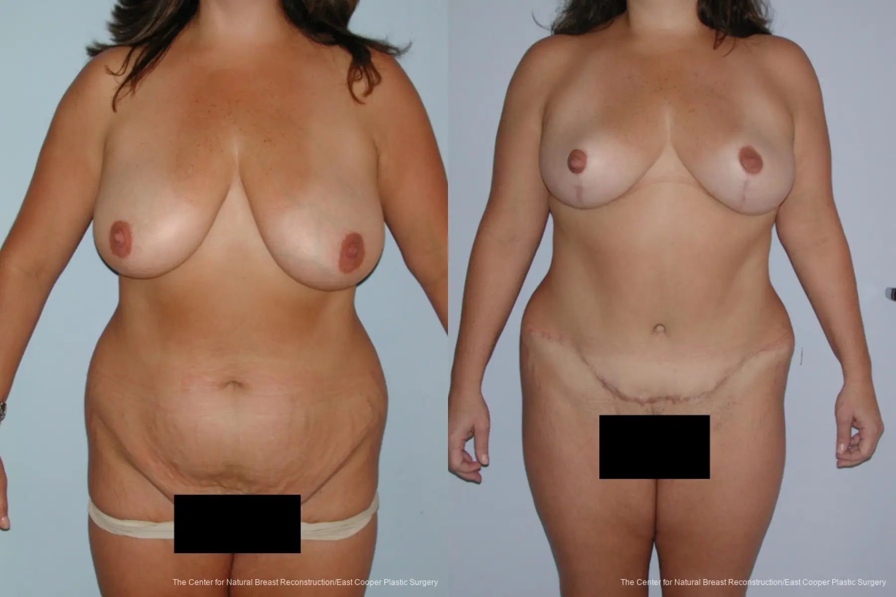 Breast Lift - Before and After