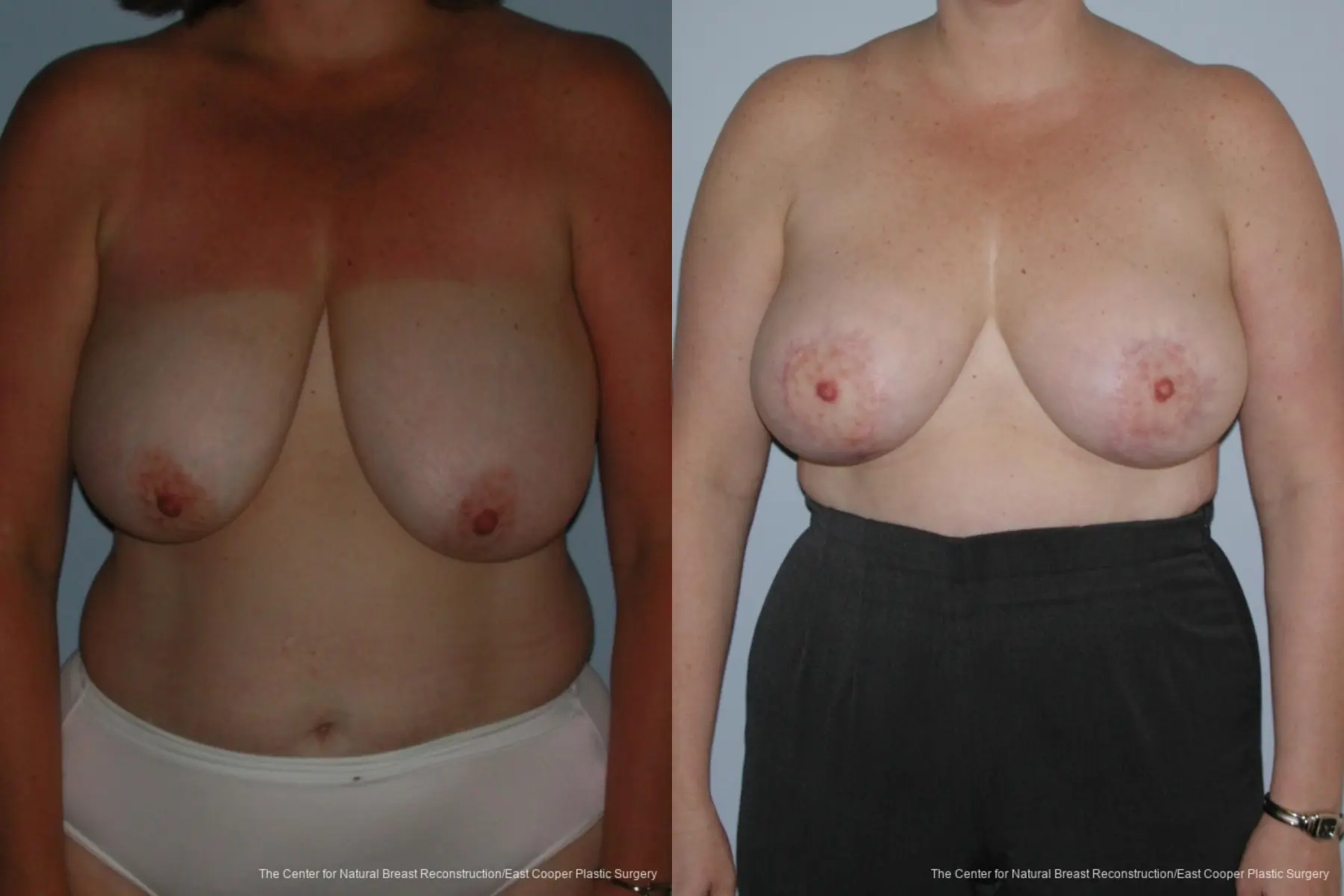 Breast Lift - Before and After