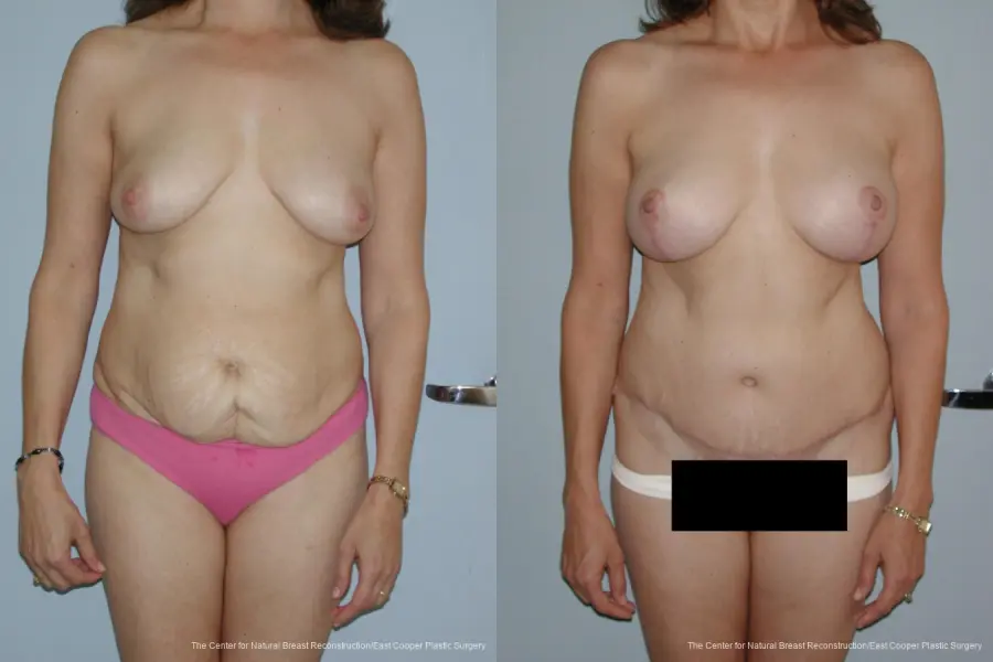 Breast Lift - Before and After