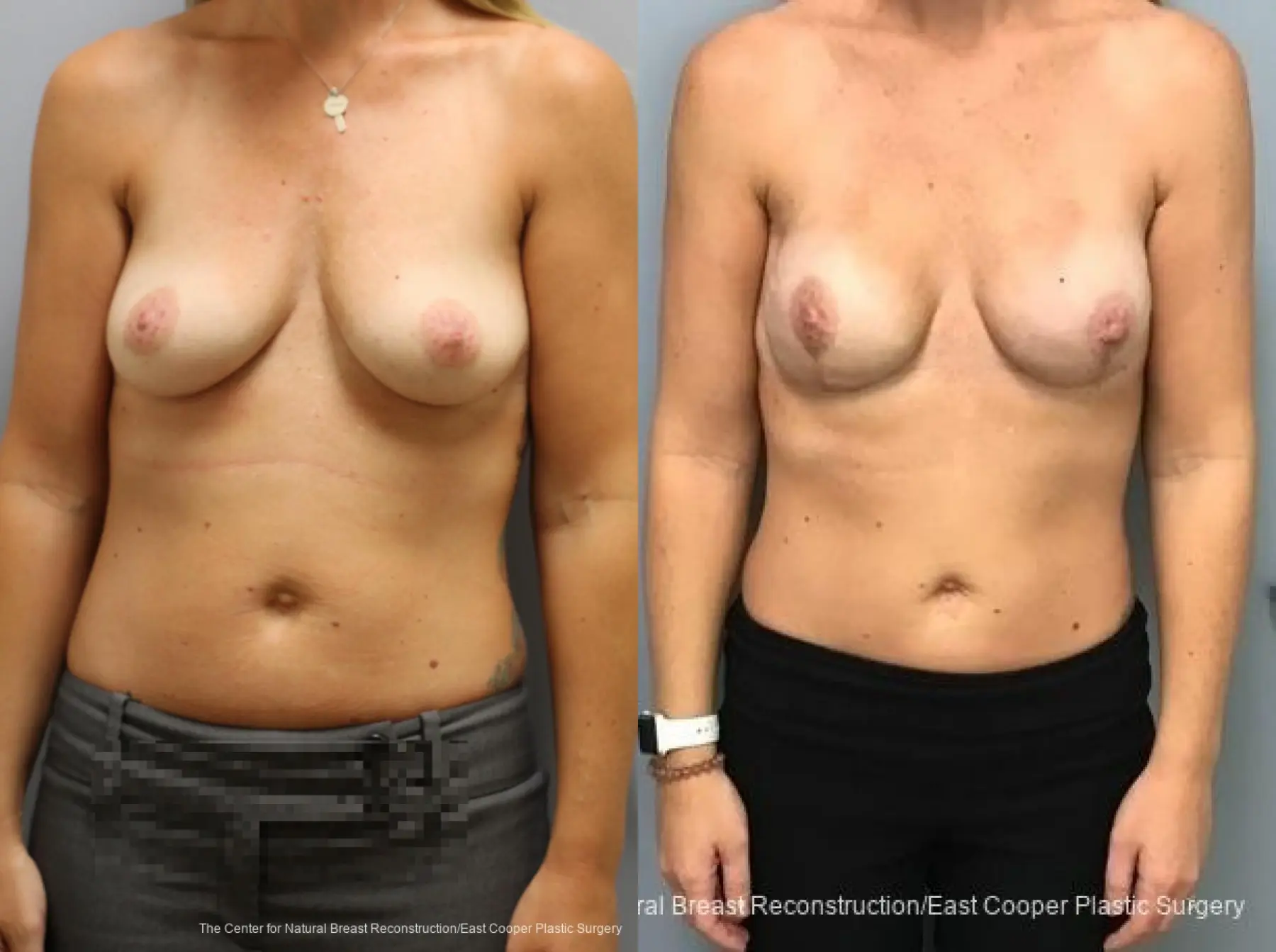 Breast Reconstruction - Before and After 1
