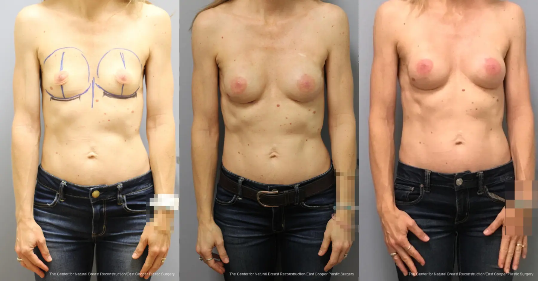 Breast Reconstruction: Patient 10 - Before and After 1