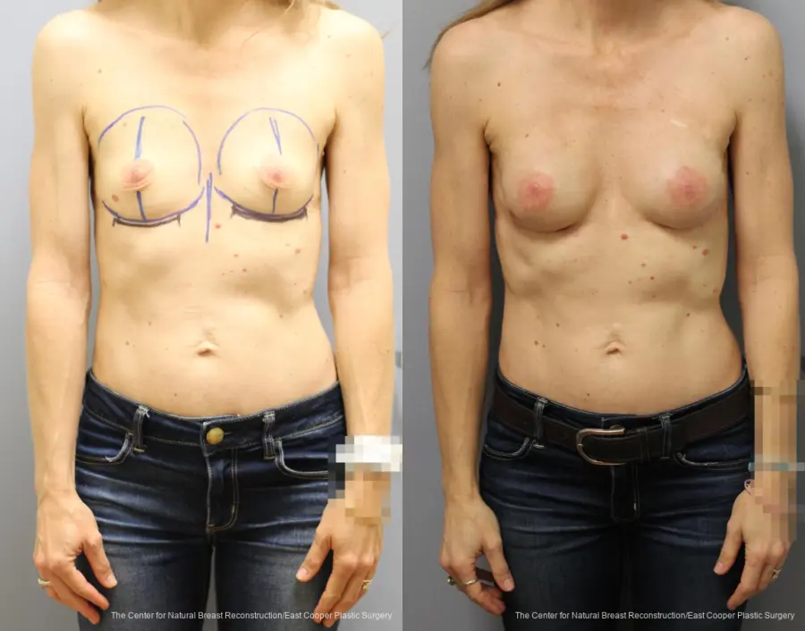 Breast Reconstruction: Patient 10 - Before and After  