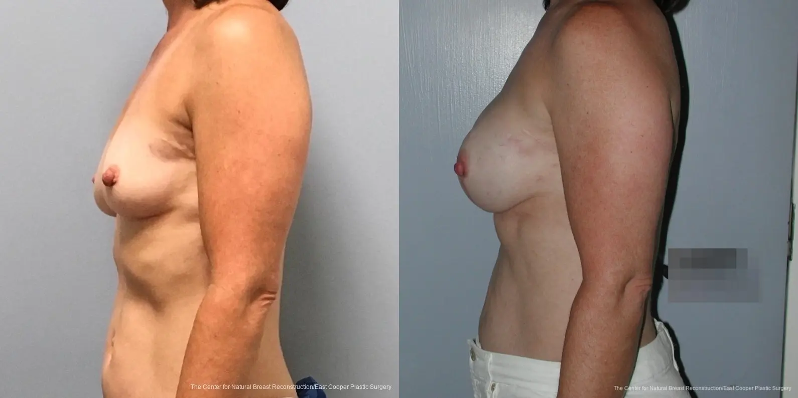 Breast Reconstruction: Patient 1 - Before and After 2