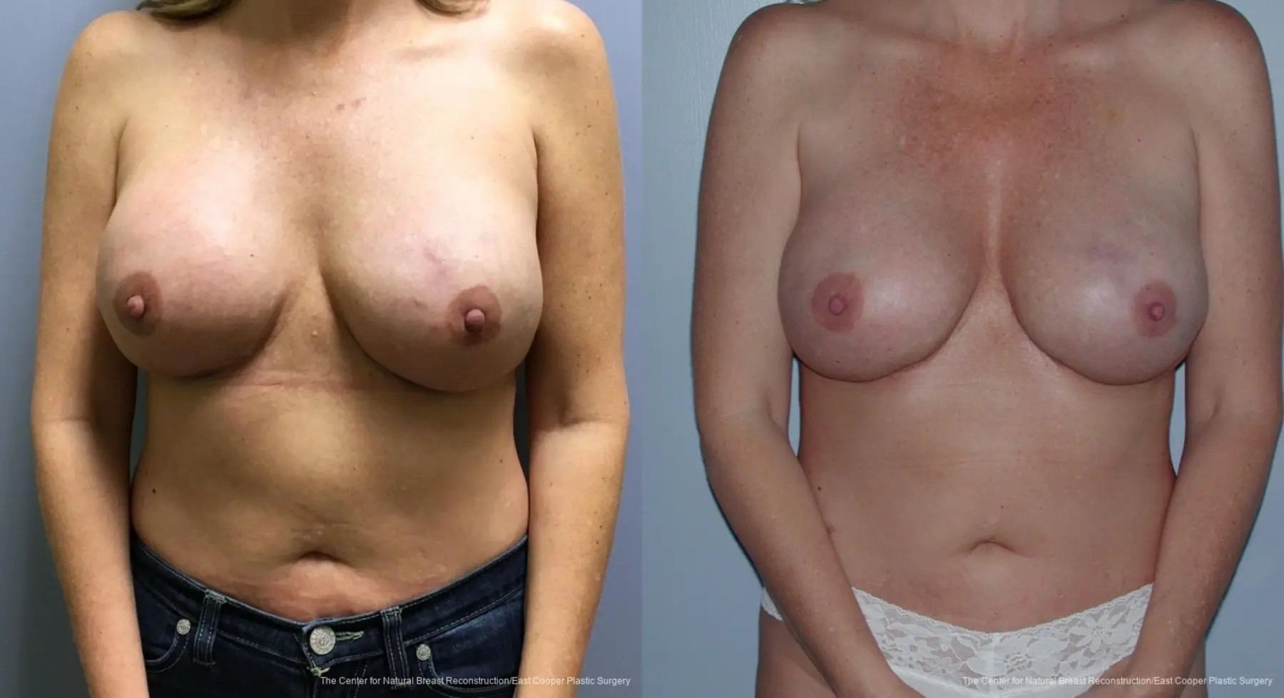 Breast Reconstruction: Patient 4 - Before and After 1