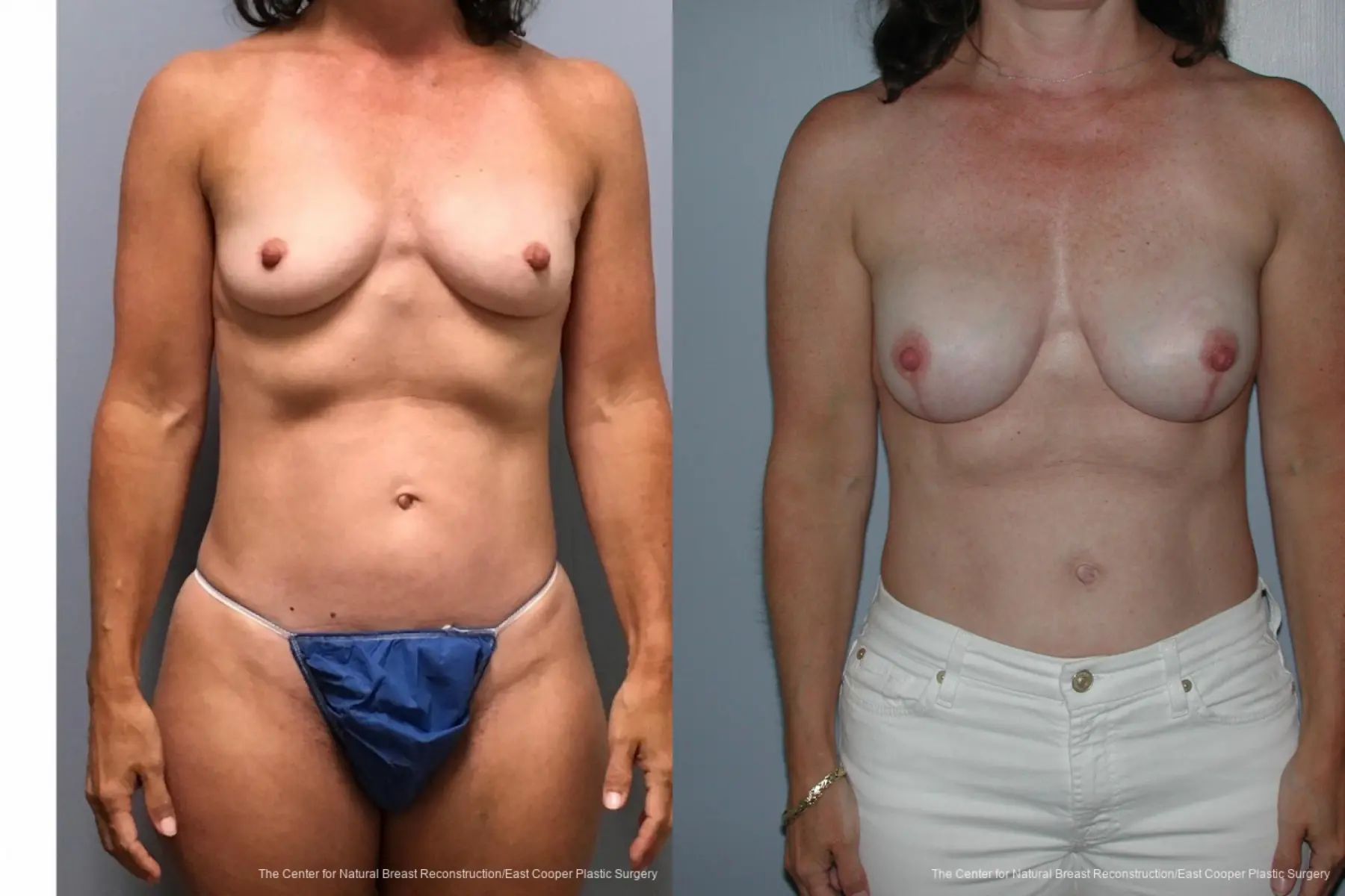 Breast Reconstruction: Patient 1 - Before and After 1