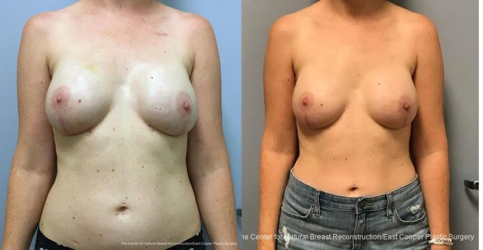 Breast Reconstruction: Patient 5 - Before and After 1