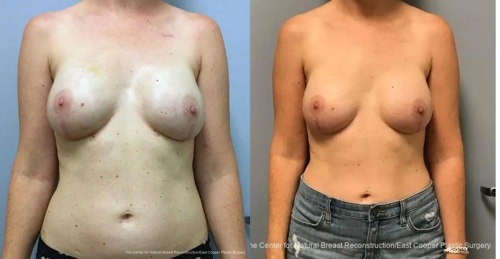 Breast Reconstruction: Patient 5 - Before and After  