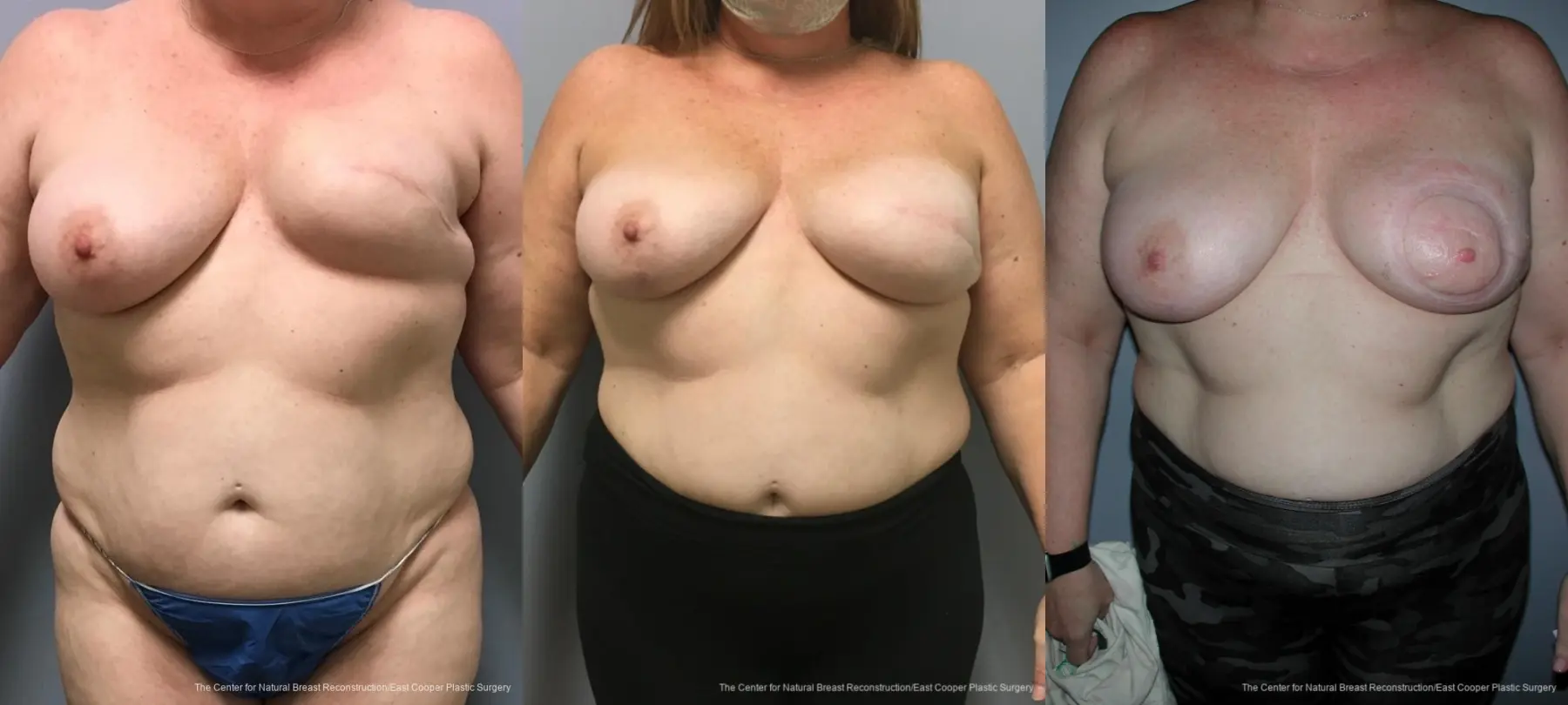 Breast Reconstruction: Patient 8 - Before and After 1