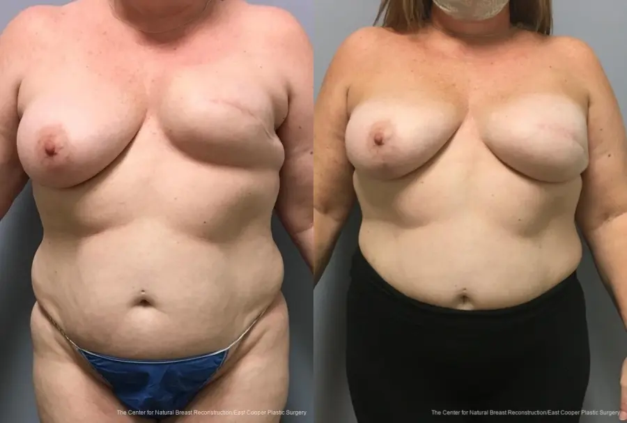 Breast Reconstruction: Patient 8 - Before and After  