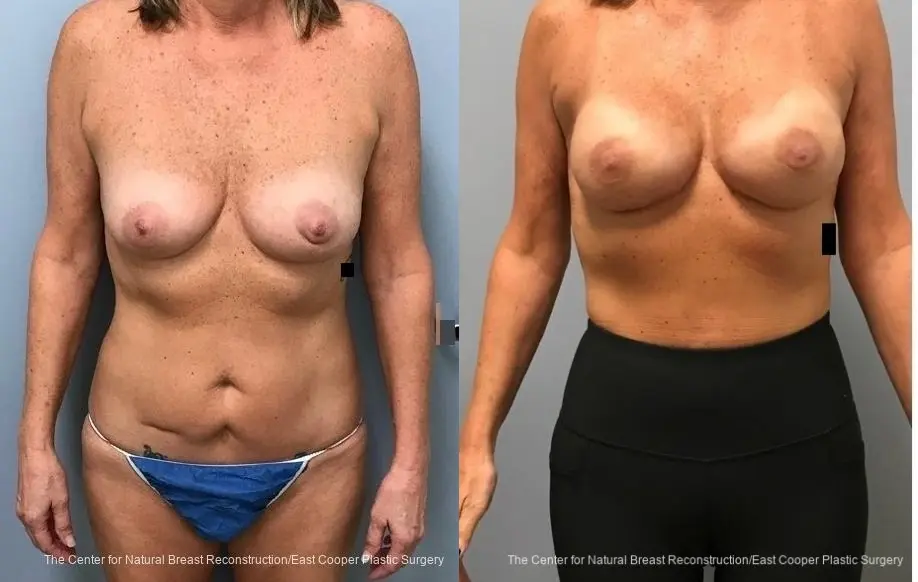 Breast Reconstruction: Patient 3 - Before and After 1