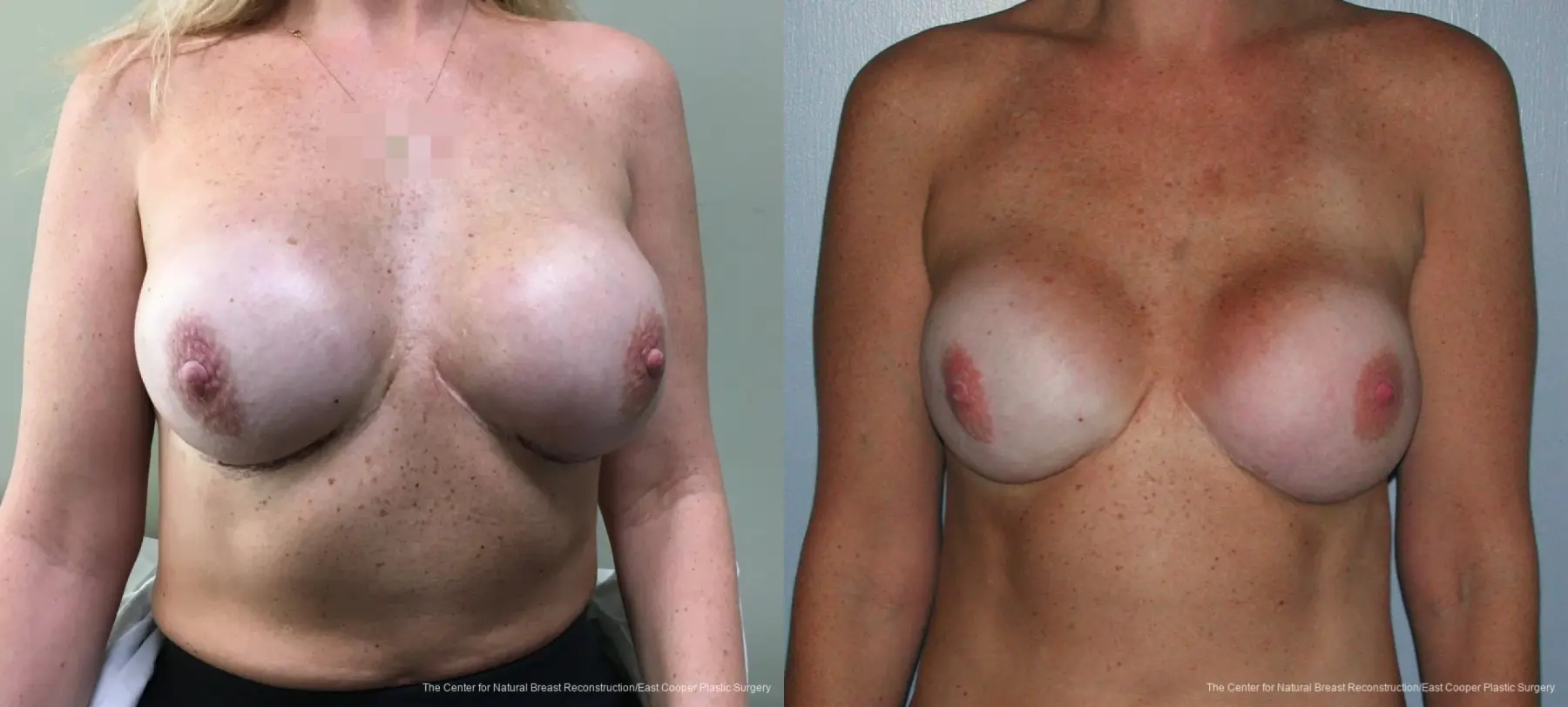 Breast Reconstruction: Patient 6 - Before and After 1