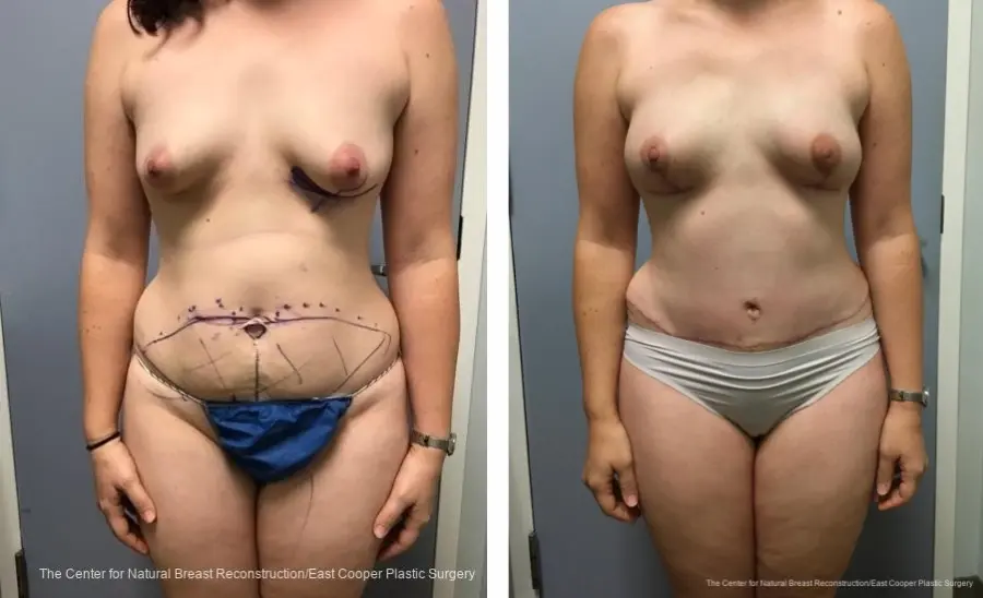 Bilateral DIEP flaps - Before and After