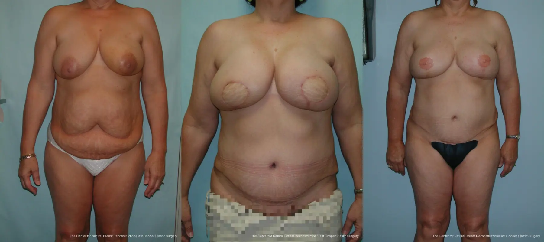 Breast Reconstruction DIEP - Before and After