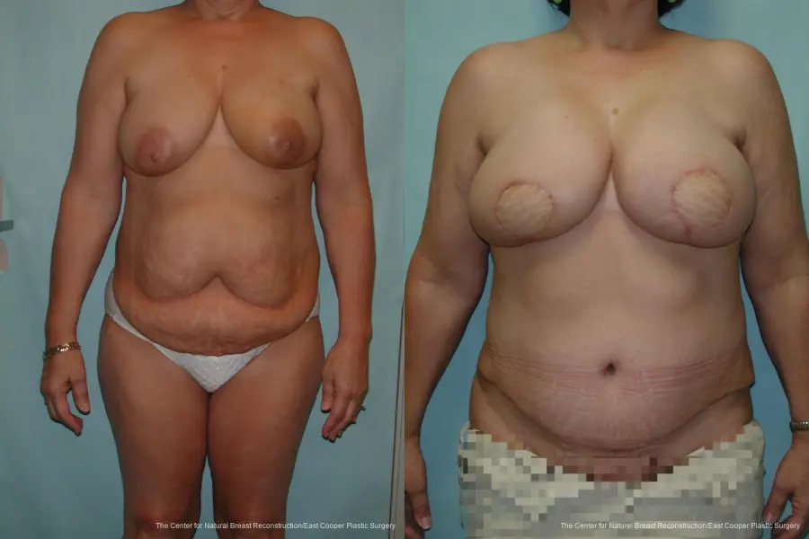 Breast Reconstruction DIEP - Before and After