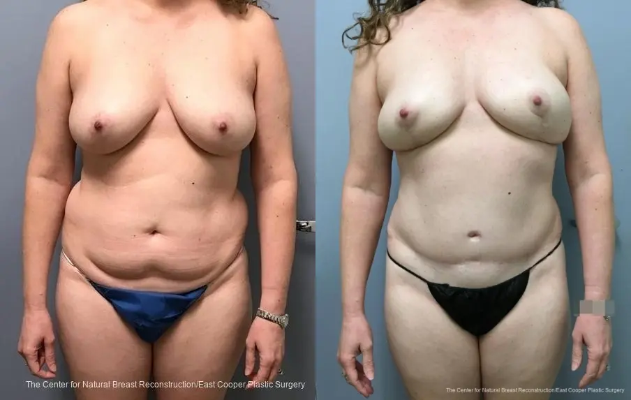 Breast Reconstruction DIEP: Patient 8 - Before and After  