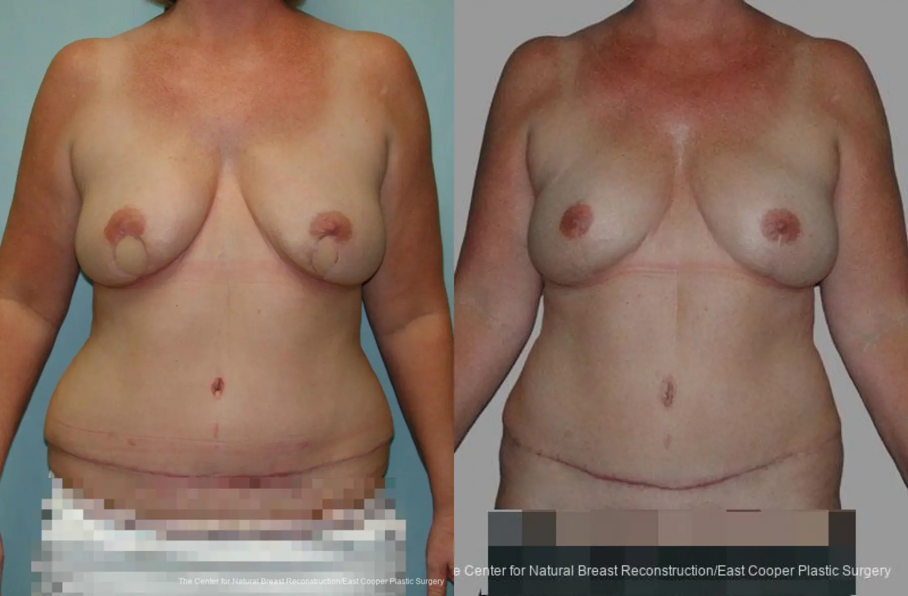 DIEP breast reconstruction - Before and After