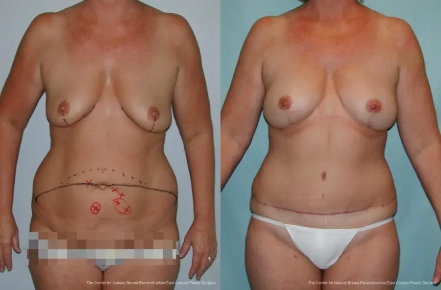Breast Reconstruction DIEP: Patient 5 - Before and After  