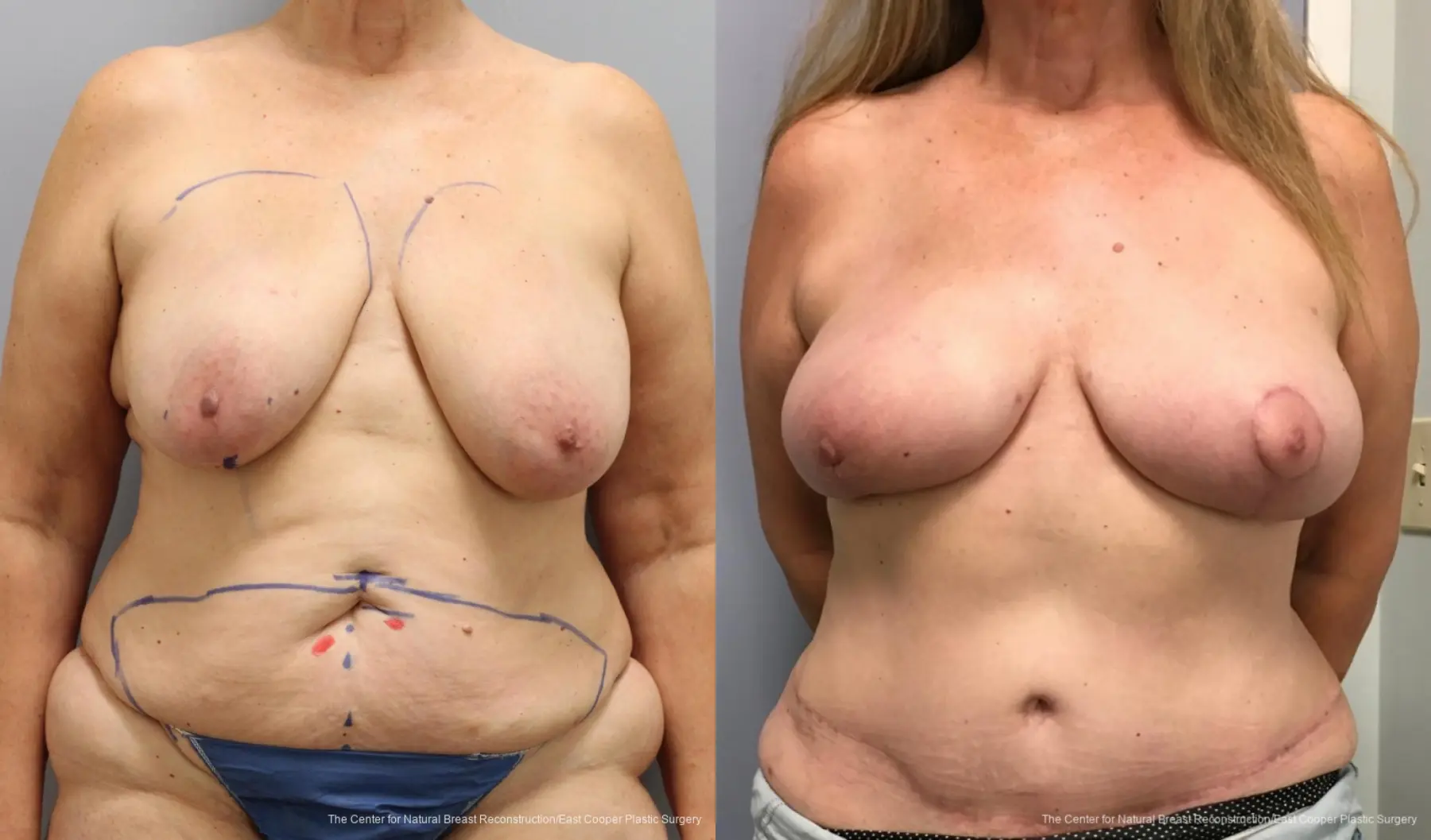 Breast Reconstruction DIEP - Before and After