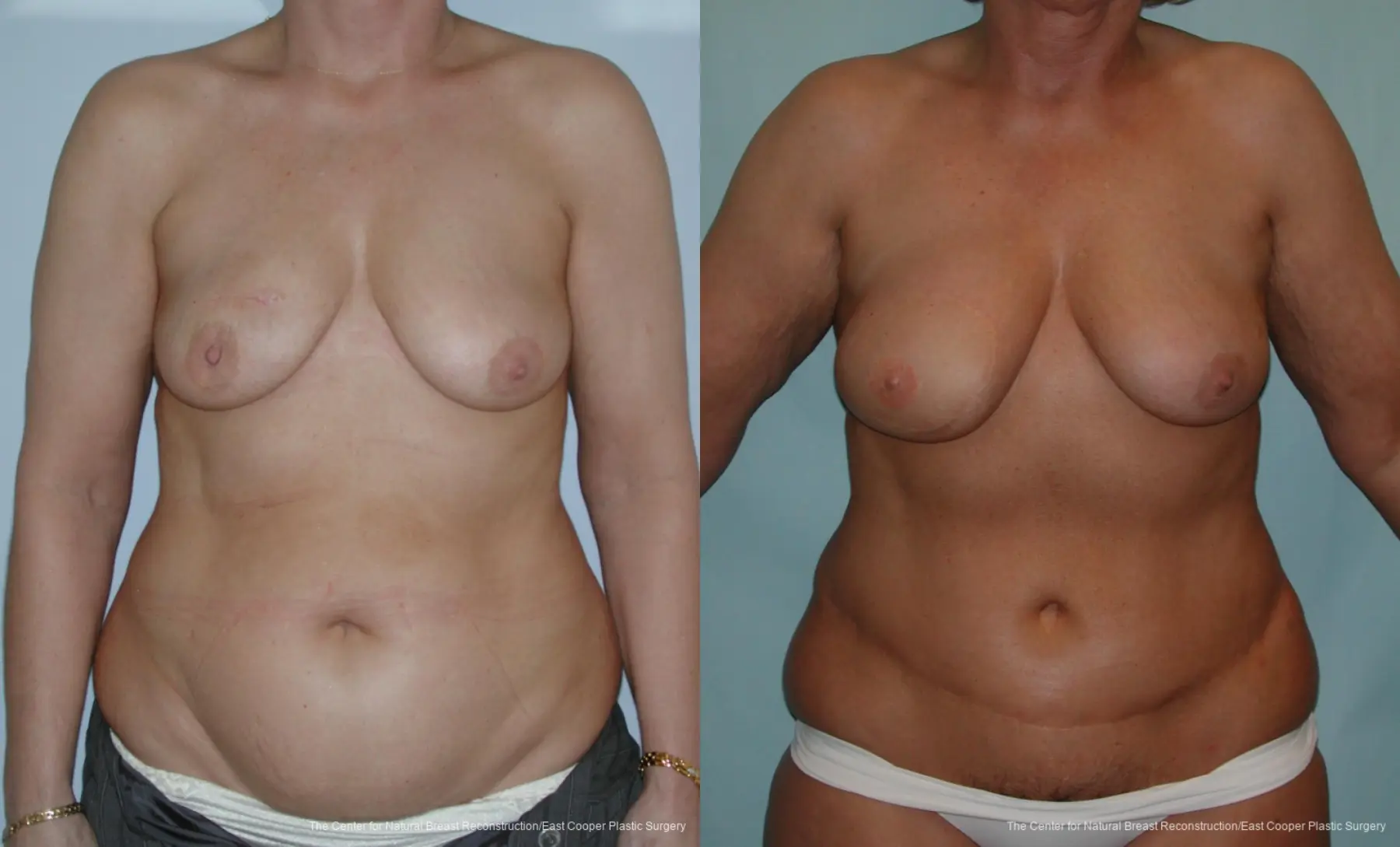Breast Reconstruction DIEP - Before and After 1
