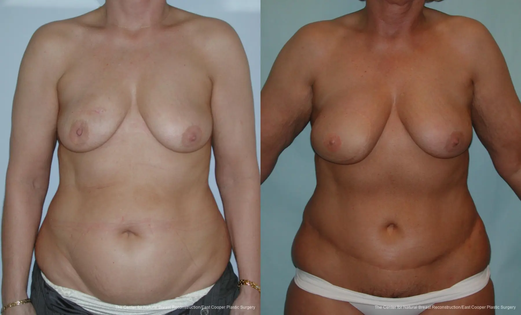 Breast Reconstruction DIEP - Before and After