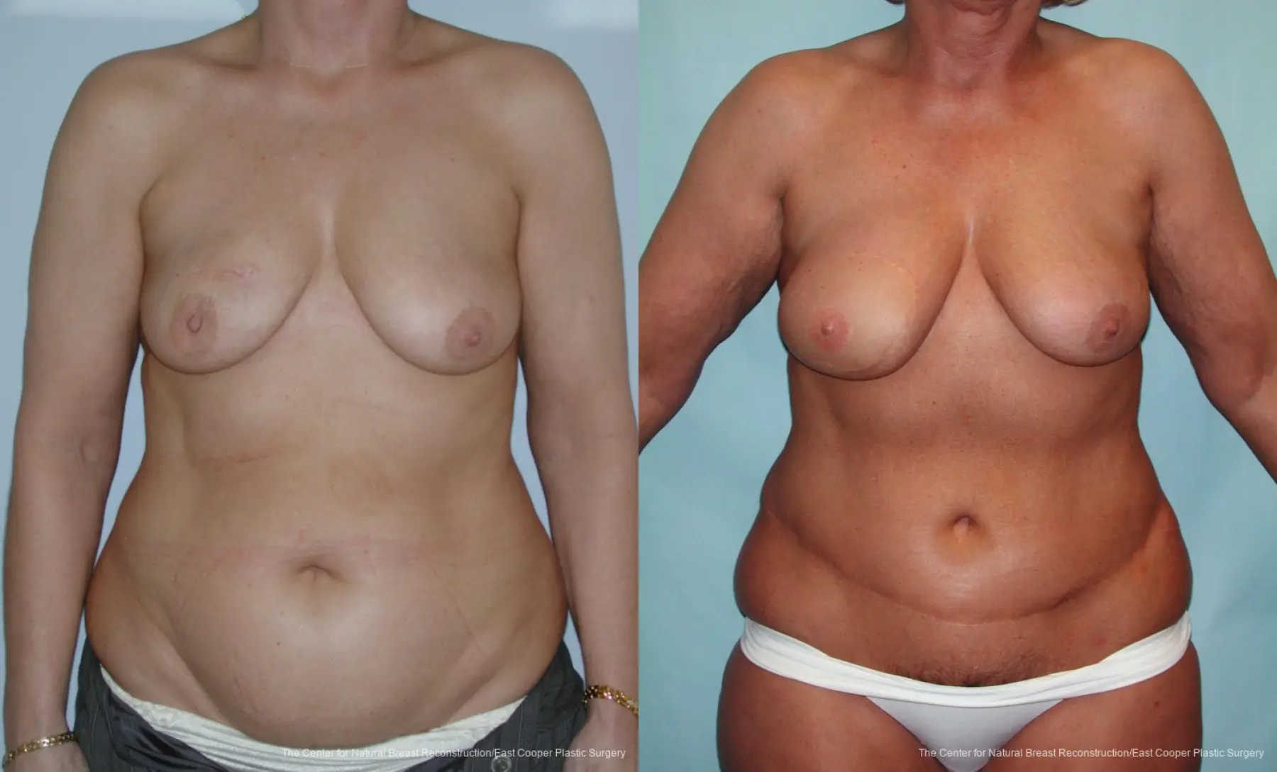 Breast Reconstruction DIEP - Before and After 1